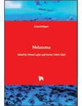 Melanoma