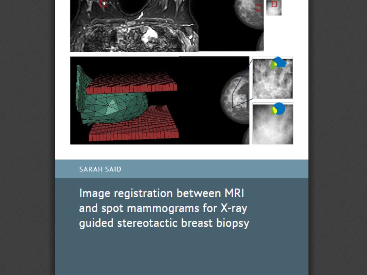 Image registration between MRI and spot mammograms for X-ray guided stereotactic breast biopsy
